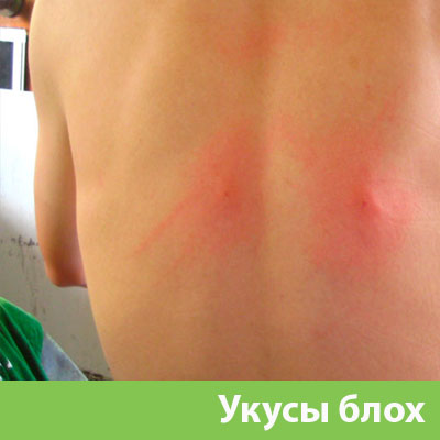 Укусы блох в Орске