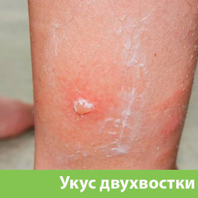 Укус двухвостки в Орске