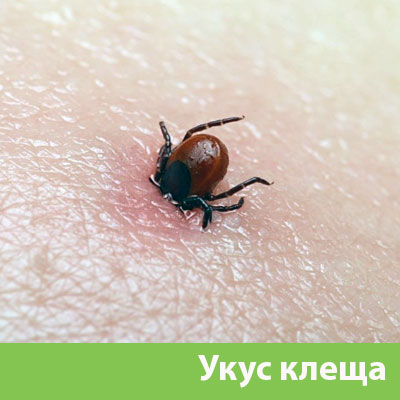 Укус клеща в Орске
