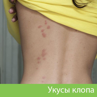 Профессиональное уничтожение клопов в Орске